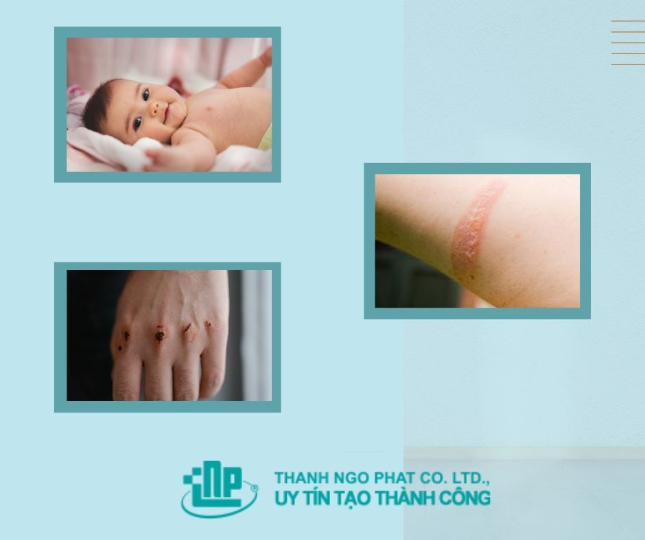 Cồn 90 độ sát trùng vết thương không